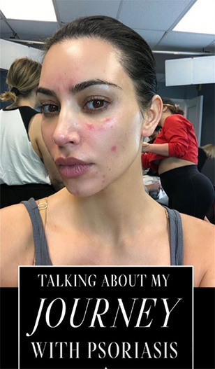 キム・カーダシアンが皮膚病の乾癬との闘病を告白