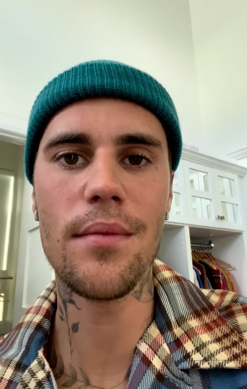 ジャスティン・ビーバー、ラムゼイ・ハント症候群で顔面麻痺の症状があることを公表 
